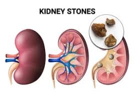 വൃക്കയിലെ കല്ല് ഇല്ലാതാക്കാനുള്ള നാടൻ വീട്ടുവൈദ്യങ്ങൾ എന്തൊക്കെയാണ്?