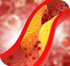 ഉയർന്ന കൊളസ്ട്രോൾ ലക്ഷണങ്ങളും അവയ്ക്കുള്ള, നാടൻ പ്രകൃതിദത്ത വീട്ടുവൈദ്യങ്ങളും
